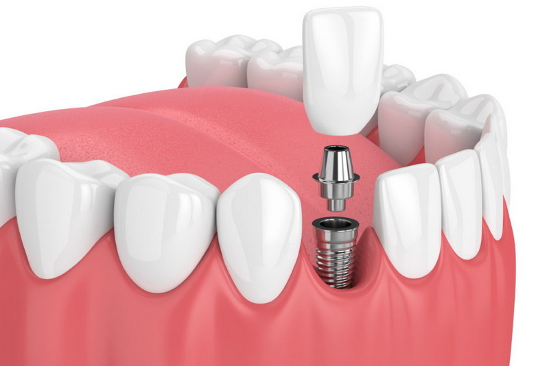 What Is The Standard Healing Abutment Size For Molars And Incisors?