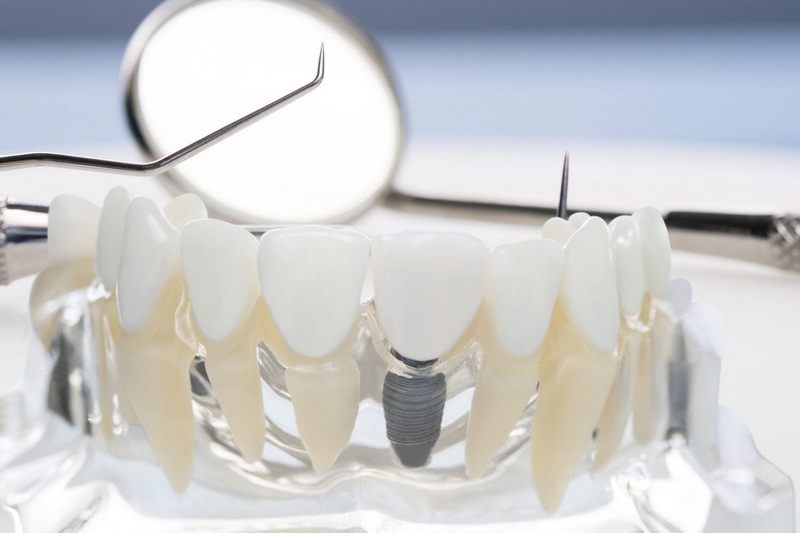Are Osstem Scan Healing Abutments Compatible With All Implant Platforms?