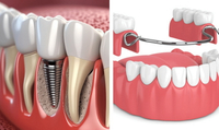 //iirorwxhloqjli5p.ldycdn.com/cloud/llBpkKloljSRillijnnjjo/osstem-healing-abutment-sizes.jpg