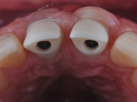 //iirorwxhloqjli5p.ldycdn.com/cloud/llBpkKloljSRillioirqjo/implant-abutment-screw-stripped.jpg