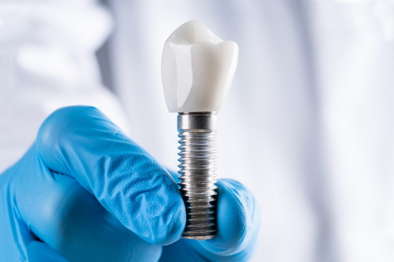 How Much Could You Save by Doing Your Own Dental Implant?