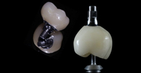 //iirorwxhloqjli5p.ldycdn.com/cloud/llBpkKloljSRilnjjokijo/prevention-of-abutment-screw-loosening.jpg