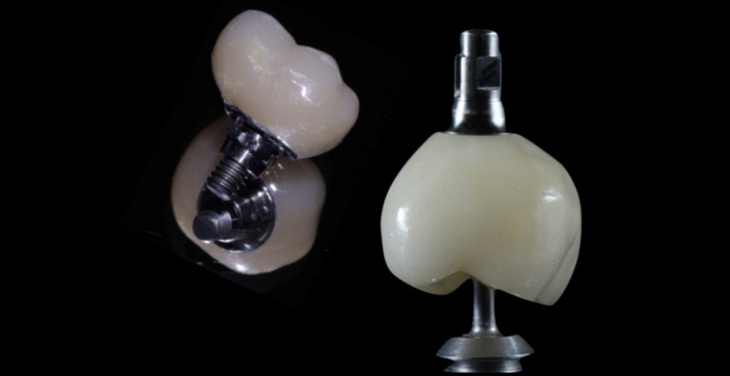 Is Removal Of A Fractured Abutment Screw Painful?