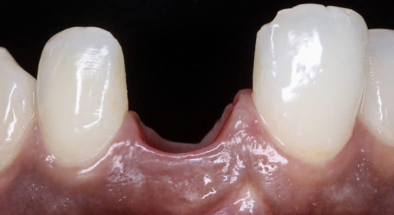 straumann healing abutment selection