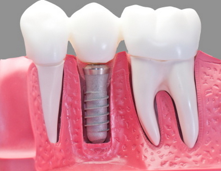 how long a dental implant lasts_16