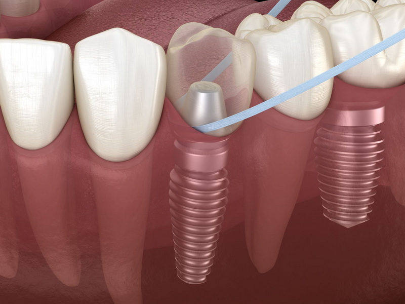 How Do You Tell If Your Dental Implant Is Infected?