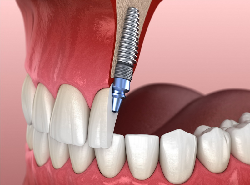 How Long To Wait To Vape After Dental Implant?