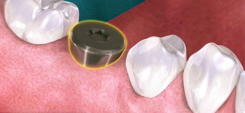 how to brush healing abutment_2