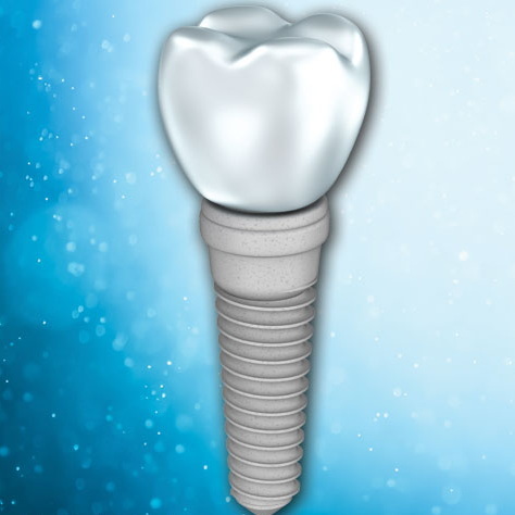 How Much Is A Front Tooth Dental Implant?