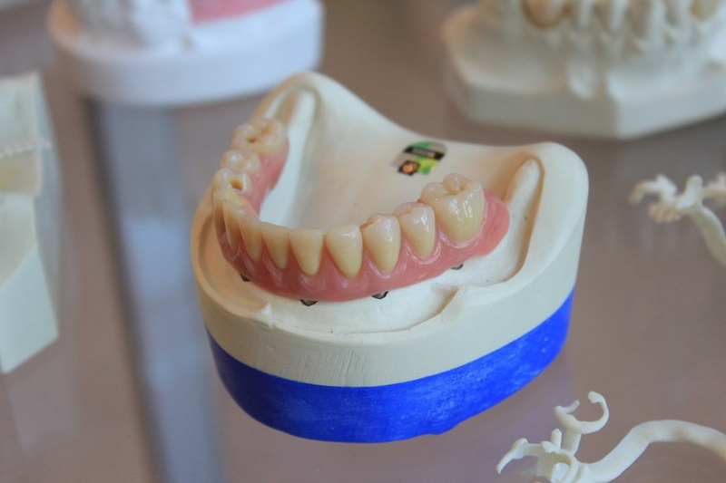 How Soon Can You Eat Normally After A Dental Implant?