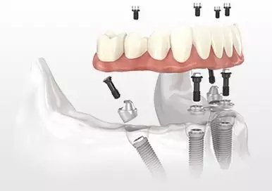 what to expect after dental implant surgery_07