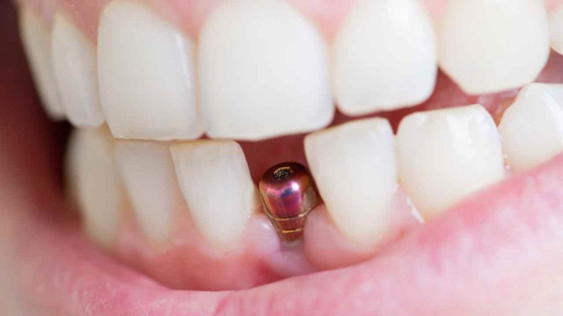 what is this dental implant_26