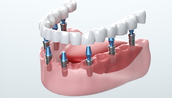 how long does a dental implant take_6