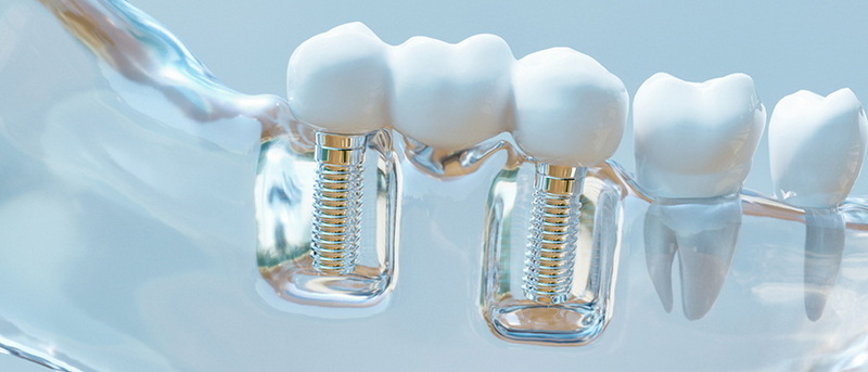 my dental implant sensitive_3