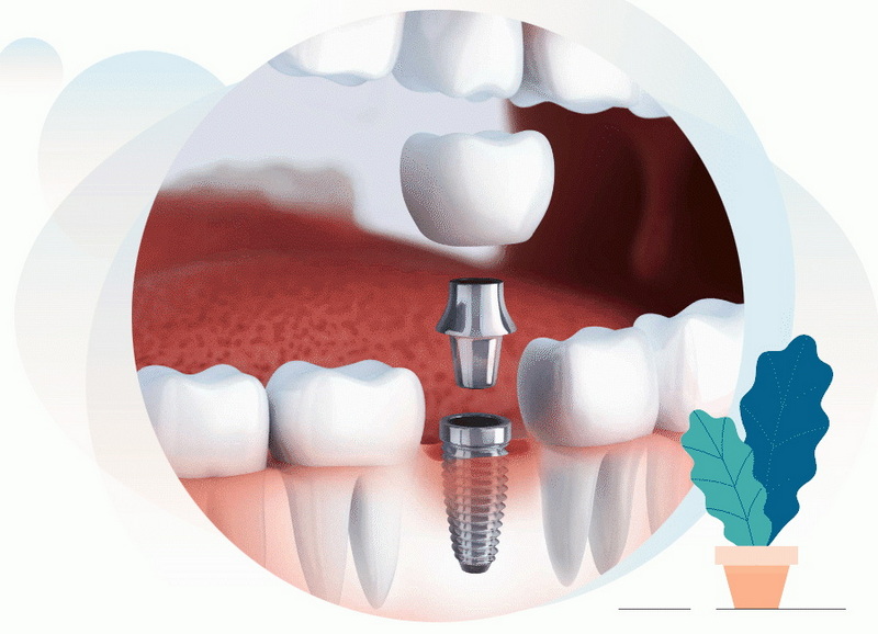 can i use mouthwash after dental implant surgery_2
