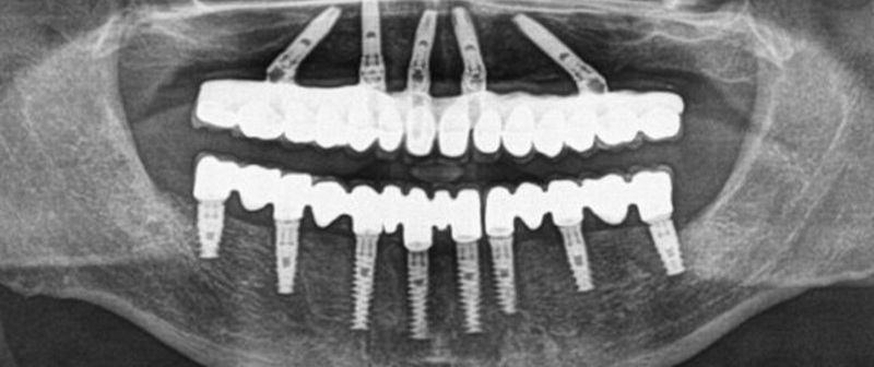 can you do mri if you have dental implant_2