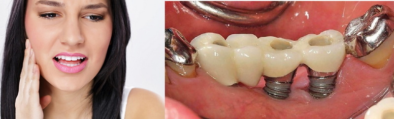 Why Not To Get A Dental Implant?