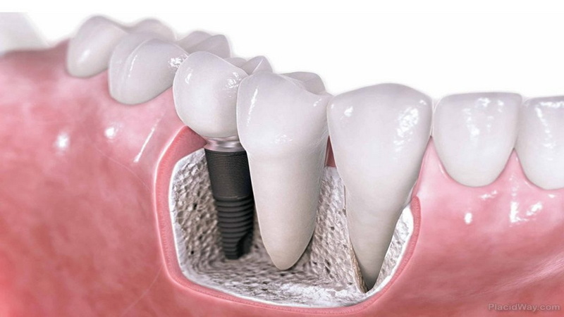 no alcohol after dental implant_2