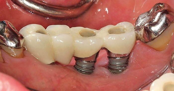 How Long Does It Take To Have A Dental Implant?