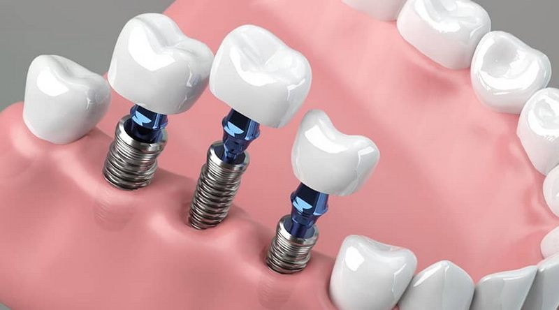 How To Stop Bleeding After Dental Implant Surgery?