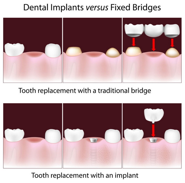 what happens when a dental implant comes out_2