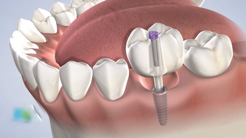 when do you need a dental implant_2