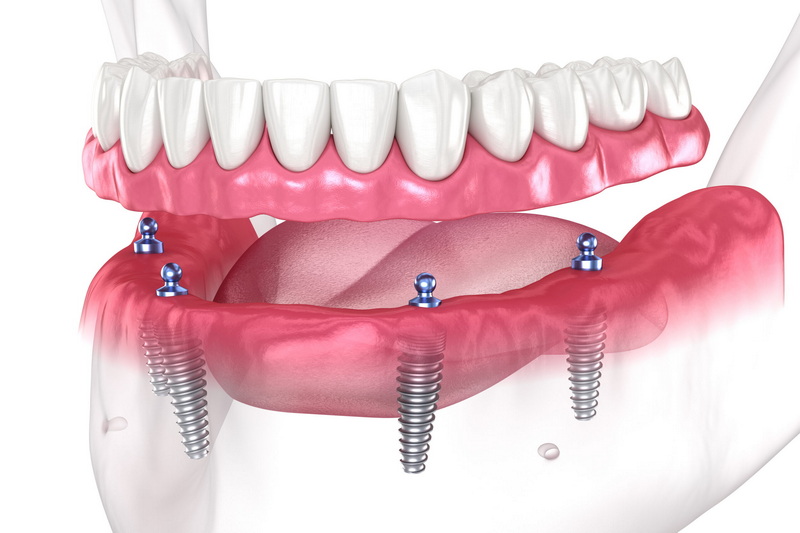 dental implant is removed_1