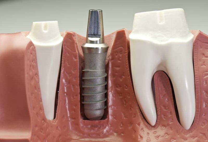 What Is The Next Step After Dental Implant?