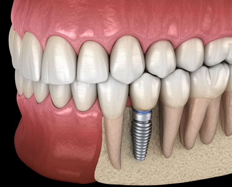 What Material Is The Dental Implant Commonly Fabricated From?