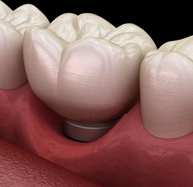 pays for failed dental implant_2