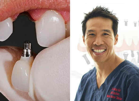 why did my dental implant fail_3