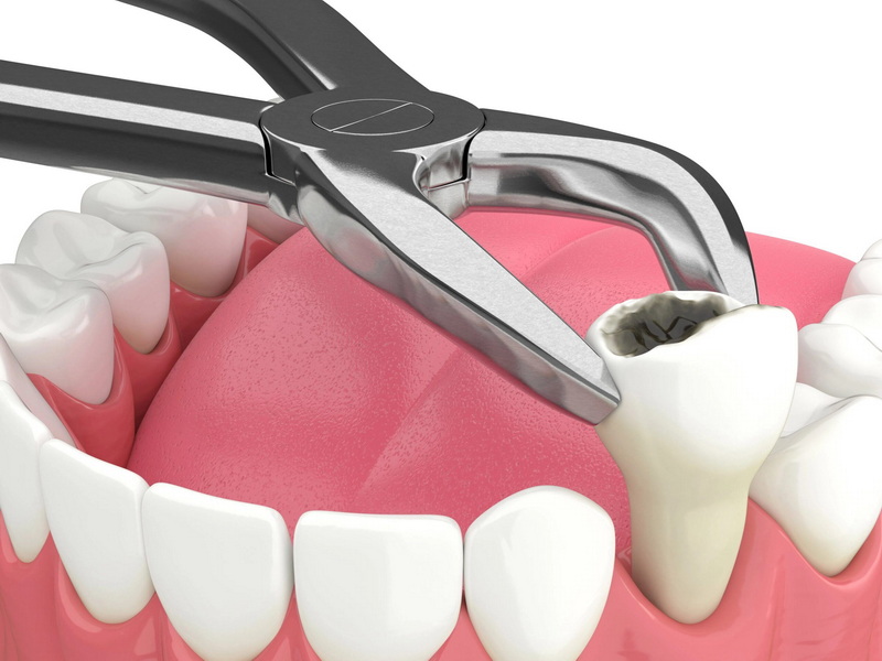 what to expect dental implant_2