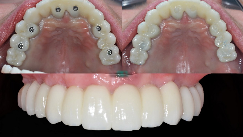 What Is The Best Dental Implant Company?