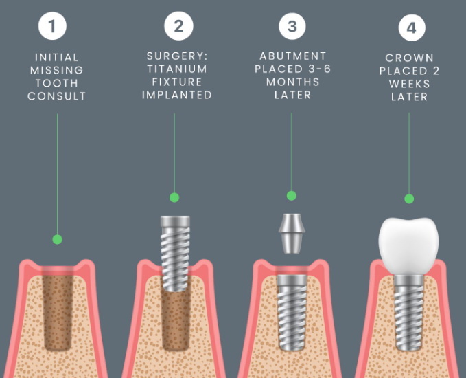 how is a dental implant done_20