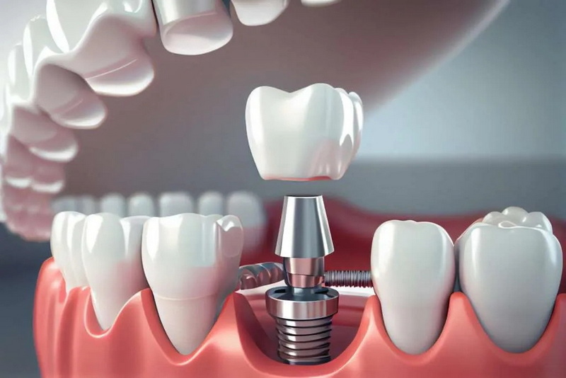 What To Expect After Dental Implant Post?