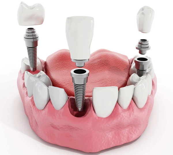 the parts of a dental implant_1