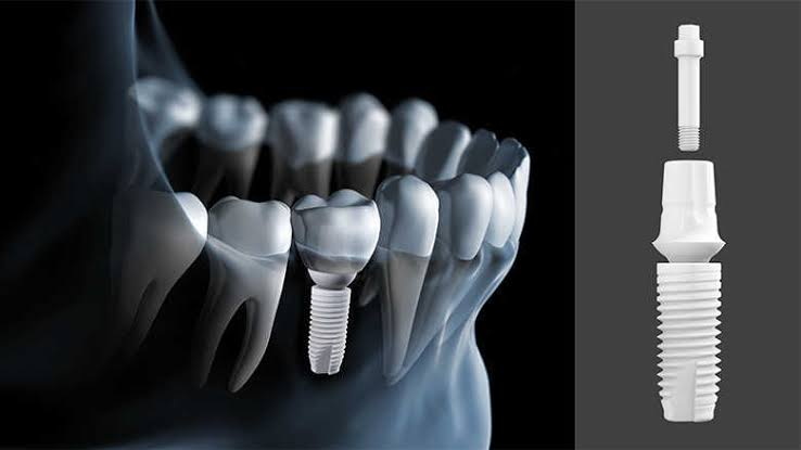 What Does A Failed Dental Implant Feel Like?