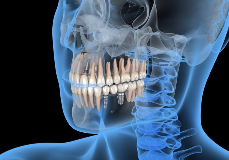 can you get a dental implant_1