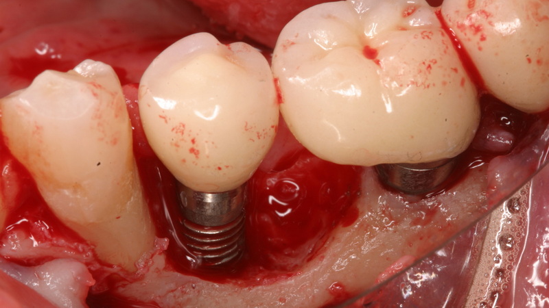 a dental implant rejection_1