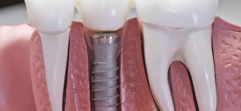 How Much Does Clearchoice Dental Implant Cost?