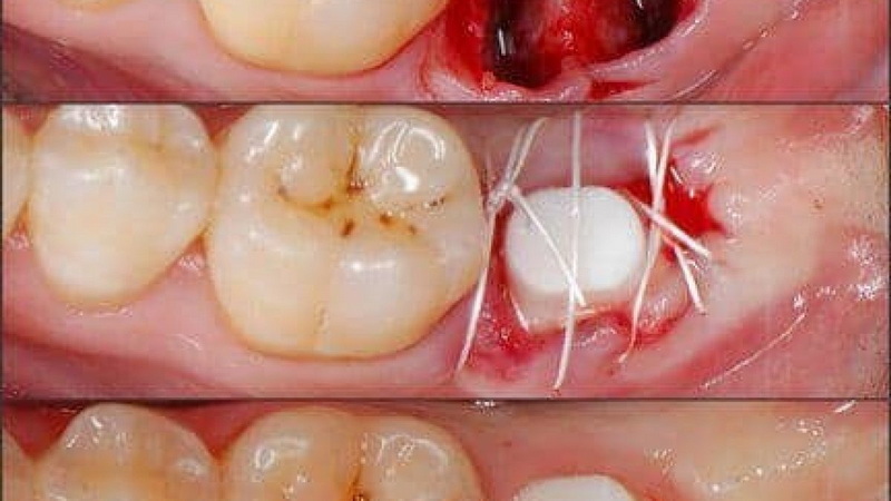 is dental implant considered cosmetic