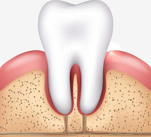 does acc cover dental implant_3
