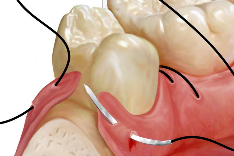 How Long It Takes for Dental Implant?