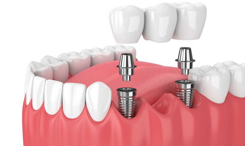 how long to have a healing abutment_3