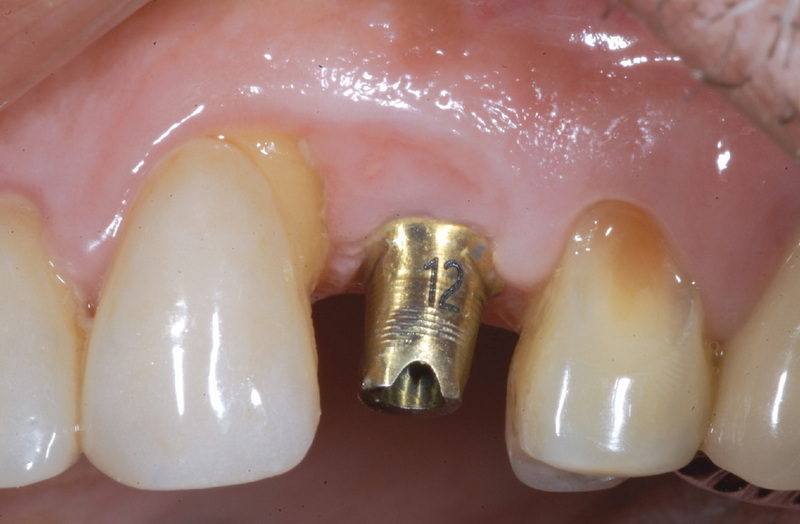 abutment screw retained implant crown