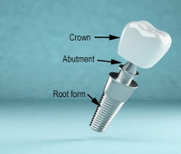 //iirorwxhloqjli5p.ldycdn.com/cloud/llBpkKloljSRrlinqqrrjo/abutment-screw-material.jpg