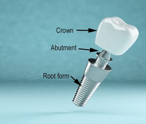 How Do Different Abutment Screw Materials Impact Bone Integration?