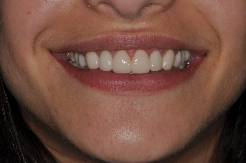 What Is A All on 4 Dental Implant?