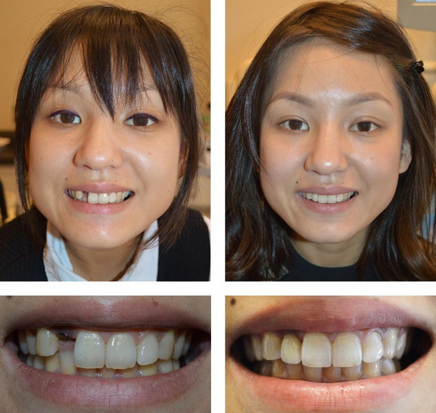 what happens if my dental implant is loose