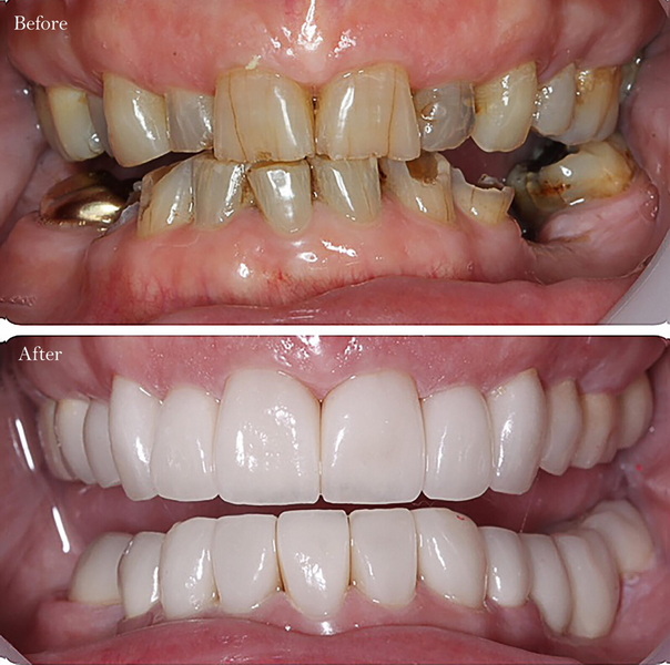what is cheaper dental implant or bridge
